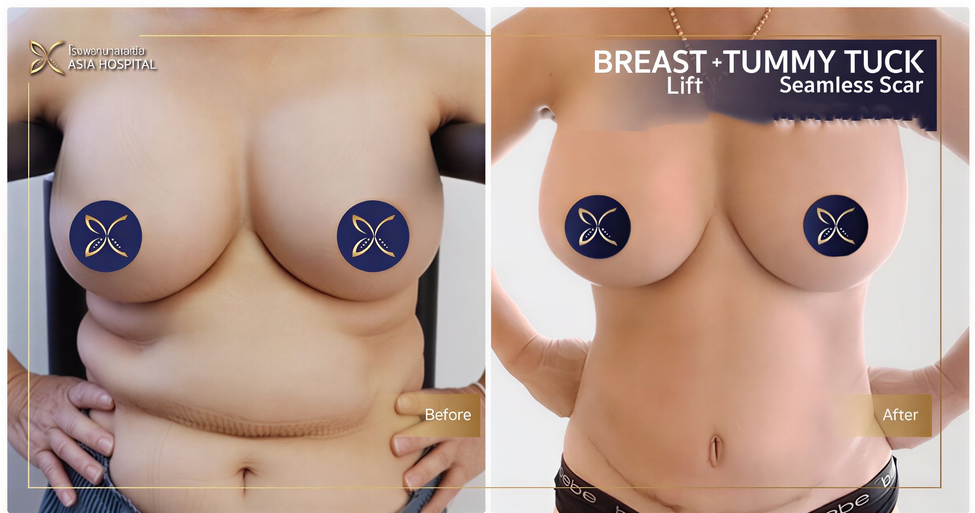 Resultados antes y después de mommy makeover en Asia Cosmetic Hospital – lifting de senos y abdomen