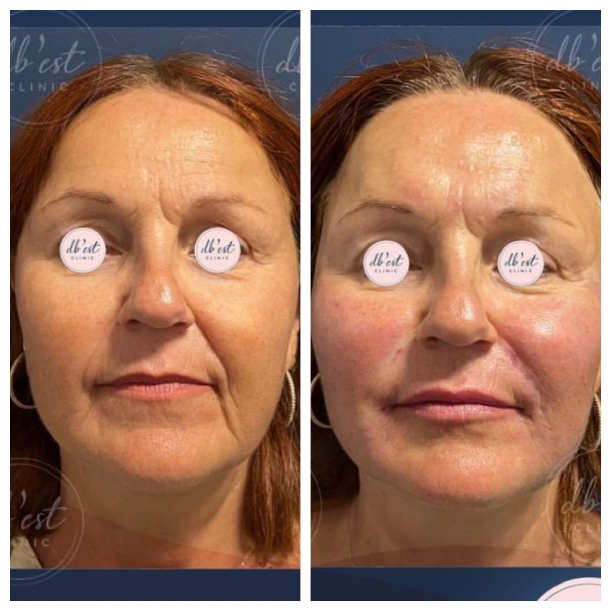 Resultados antes y después de rellenos en Db'est Clinic, rejuvenecimiento y restauración facial