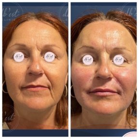 Before and after fillers injection result at Db'est Clinic, facial rejuvenation and volume restoration