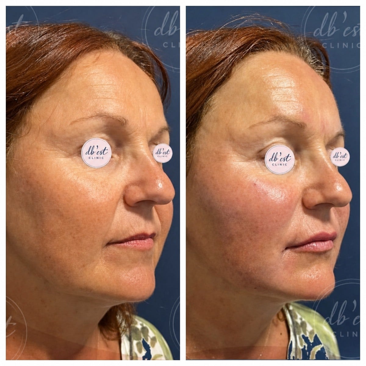 Antes y después de inyecciones de relleno en Db'est Clinic, restauración facial y rejuvenecimiento