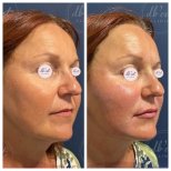 Before and after fillers injection at Db'est Clinic, facial volume restoration and rejuvenation result