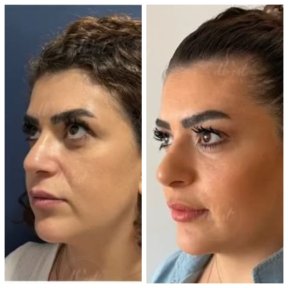 Before and after fillers injection result at Db'est Clinic, enhanced facial volume and contour