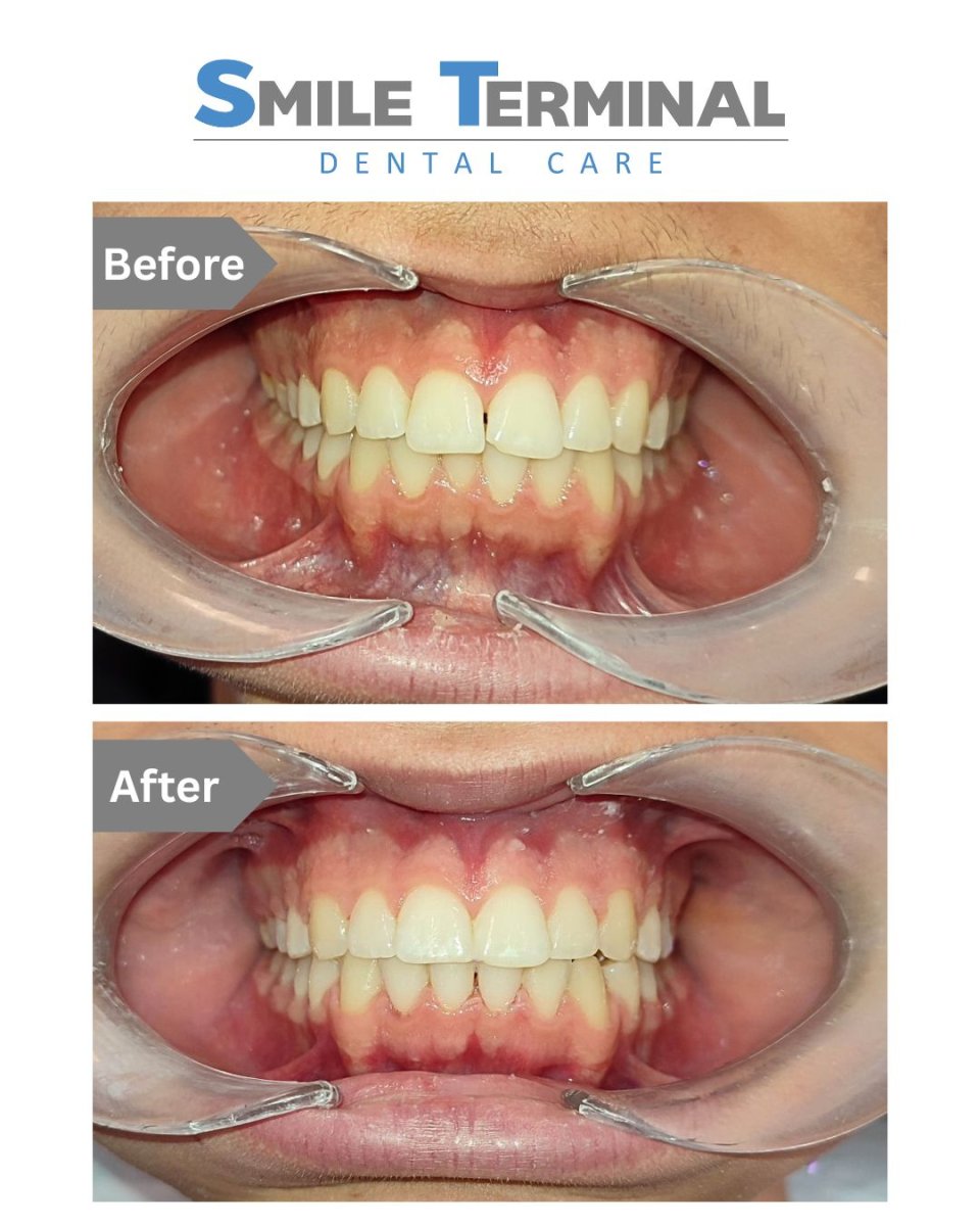 Resultados antes y después de alineadores transparentes en Smile Terminal Dental Care – dientes rectos