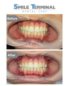 نتائج قبل وبعد تقويم الأسنان الشفاف في Smile Terminal Dental Care – أسنان أكثر انتظامًا