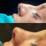 Vorher-nachher-Ergebnis der offenen Rhinoplastik in der Dr. Safa Manav Klinik, Nasenkorrektur