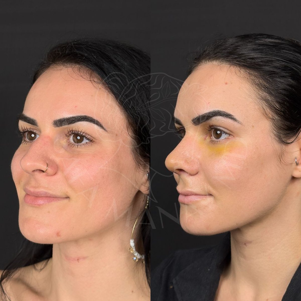 نتائج قبل وبعد عملية تجميل الأنف المفتوحة في عيادة Dr. Safa Manav، إعادة تشكيل الأنف