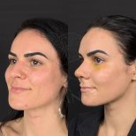 Vorher-nachher-Ergebnis der offenen Rhinoplastik in der Dr. Safa Manav Klinik, Nasenkorrektur