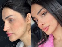 Vorher-nachher-Ergebnis der offenen Rhinoplastik in der Dr. Safa Manav Klinik, Nasenkorrektur