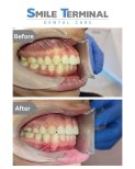 Vorher-nachher-Ergebnis Zahnspange für Kinder bei Smile Terminal Dental Care, Zahnkorrektur