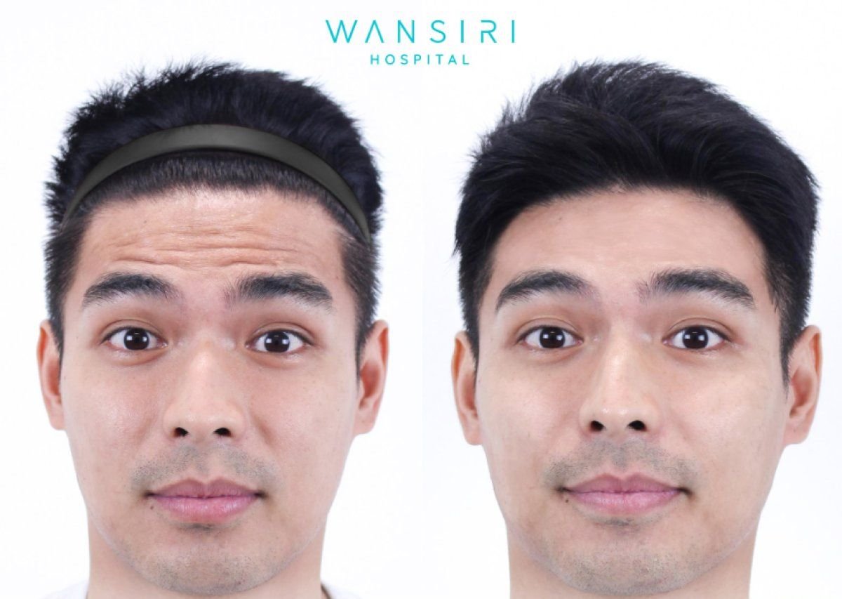 Avant et après injections de Botox à Wansiri Hospital, réduction visible des rides du front