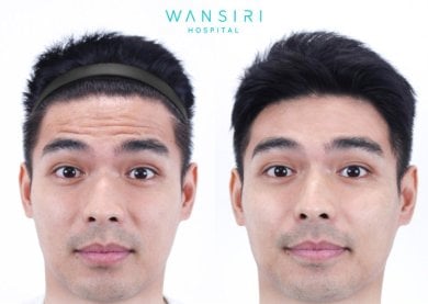 До і після ін'єкцій ботоксу у Wansiri Hospital, помітне зменшення зморшок на лобі