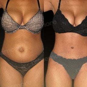 Before and after abdominal liposuction results at Memorial Şişli Hospital, slimmer waistline