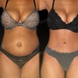 Before and after abdominal liposuction results at Memorial Şişli Hospital, slimmer waistline