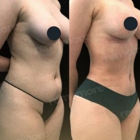 Before and after abdominal liposuction results at Memorial Şişli Hospital, body contouring