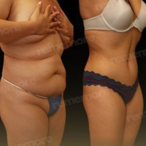 Before and after abdominal liposuction results at Memorial Şişli Hospital, slimmer waistline