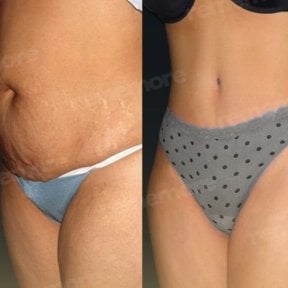 Before and after abdominal liposuction results at Memorial Şişli Hospital, slimmer waistline