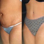 Before and after abdominal liposuction results at Memorial Şişli Hospital, slimmer waistline