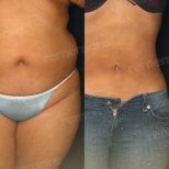 Before and after abdominal liposuction results at Memorial Şişli Hospital, slimmer waistline