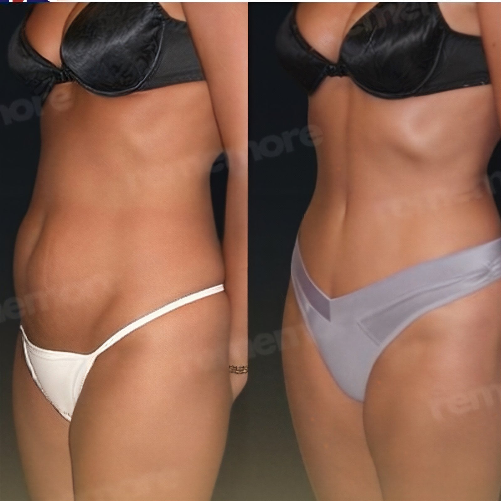 Resultados de liposucción abdominal antes y después en Memorial Şişli Hospital, cintura más delgada
