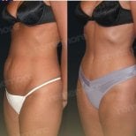 Before and after abdominal liposuction results at Memorial Şişli Hospital, slimmer waistline