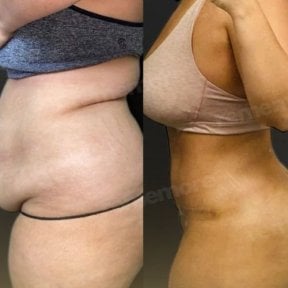 Before and after abdominal liposuction results at Memorial Şişli Hospital, slimmer waistline