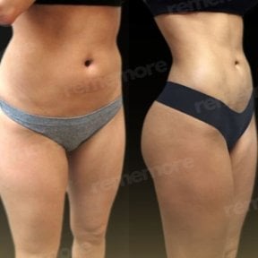 Before and after abdominal liposuction results at Memorial Şişli Hospital, slimmer waistline