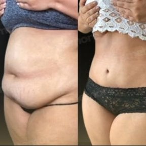 Before and after abdominal liposuction results at Memorial Şişli Hospital, slimmer waistline