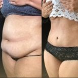 Before and after abdominal liposuction results at Memorial Şişli Hospital, slimmer waistline