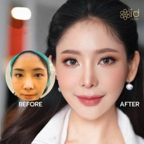 Before and after upper eyelid surgery results at ID Clinic Bangkok, brighter eye appearance