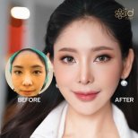 Before and after upper eyelid surgery results at ID Clinic Bangkok, brighter eye appearance