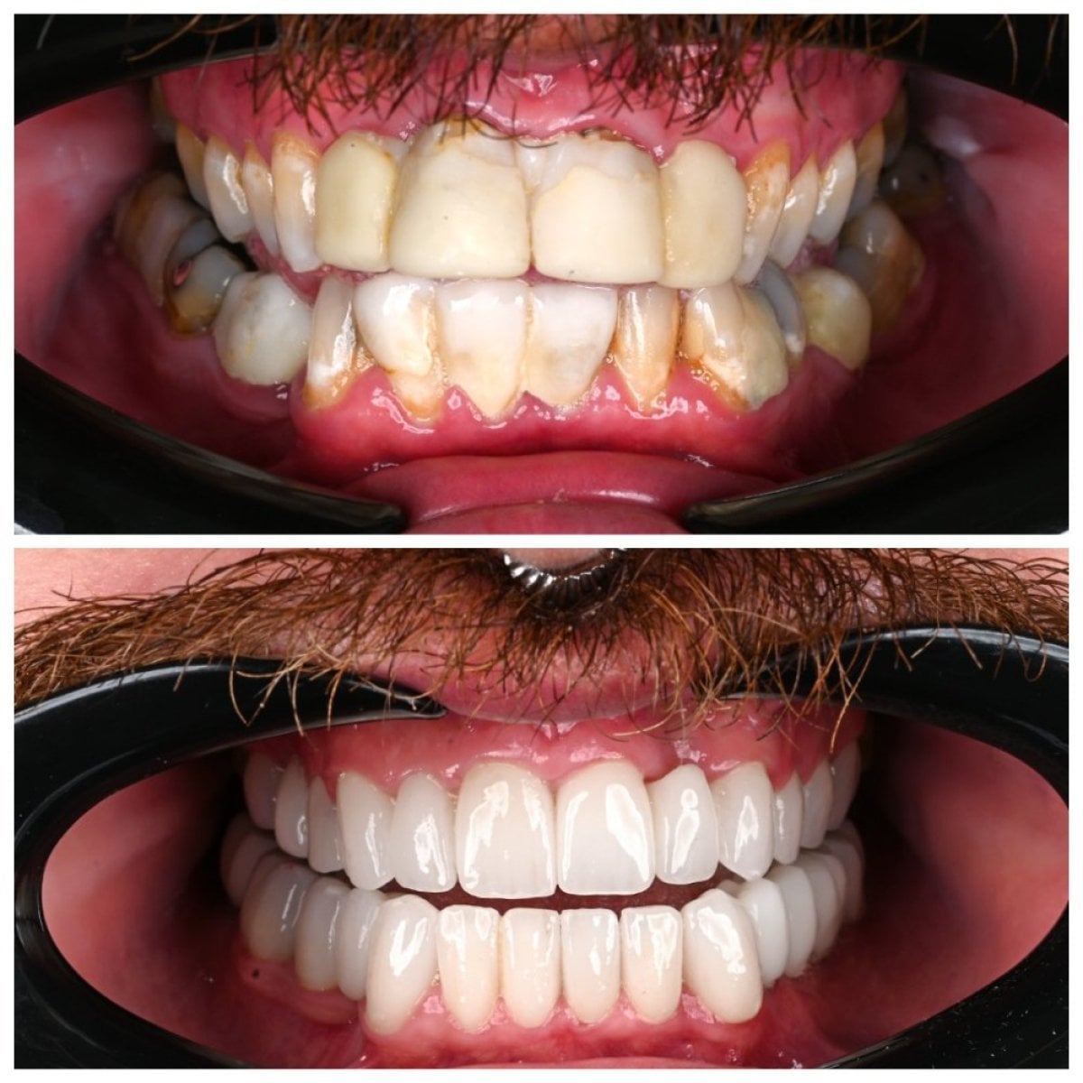 Resultados antes y después de coronas dentales en Soraca Med – mejora estética de la sonrisa