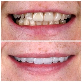 قبل وبعد تركيب تيجان الزركونيا في Soraca Med – تحسين جمالية الابتسامة