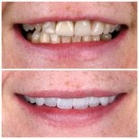 قبل وبعد تركيب تيجان الزركونيا في Soraca Med – تحسين جمالية الابتسامة