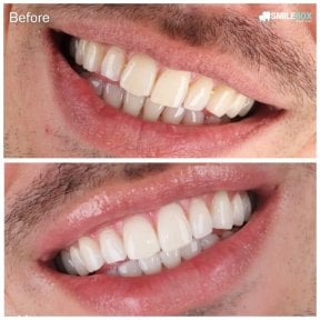 Результаты до и после отбеливания зубов в SmileBox Dental Clinic - Thonglor, Sukhumvit Branch