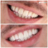 Результаты до и после отбеливания зубов в SmileBox Dental Clinic - Thonglor, Sukhumvit Branch