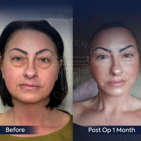 Before and after neck lift results at Dr. Safa Manav Clinic, visible skin tightening effect