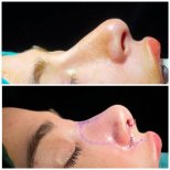 نتائج تجميل الأنف قبل وبعد في Risus Clinic Istanbul، تغيير واضح لشكل الأنف