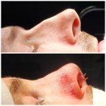 نتيجة عملية تجميل الأنف قبل وبعد في Risus Clinic Istanbul مع إعادة تشكيل واضحة للأنف