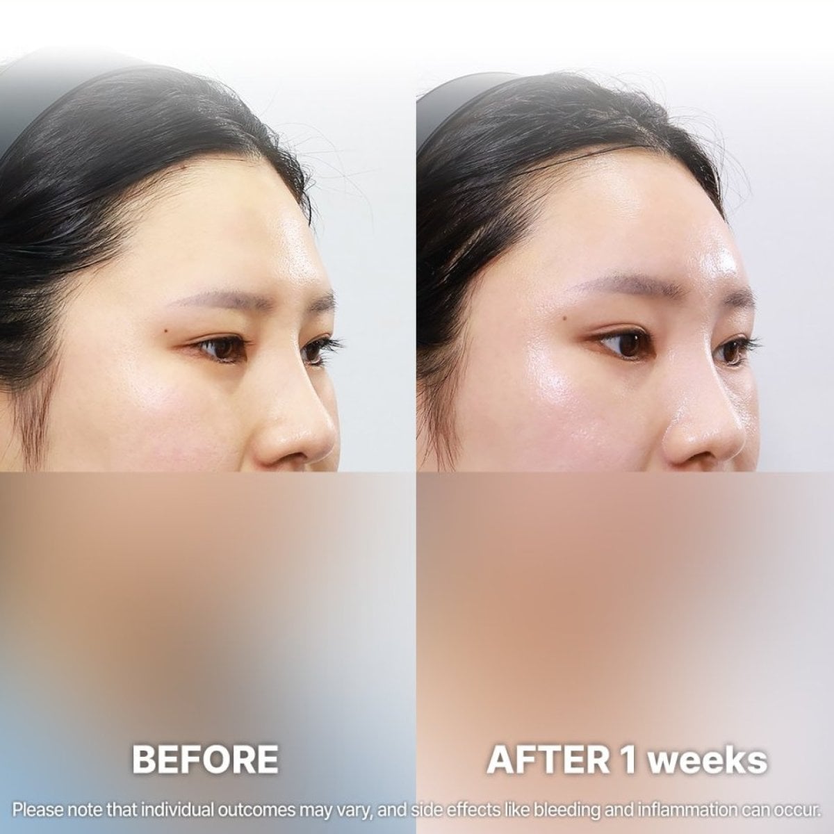 نتائج شد الجبهة قبل وبعد في Returning Plastic Surgery، رفع واضح للحاجب