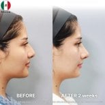 نتائج تجميل الأنف قبل وبعد في Returning Plastic Surgery، إعادة تشكيل الأنف بعد أسبوعين