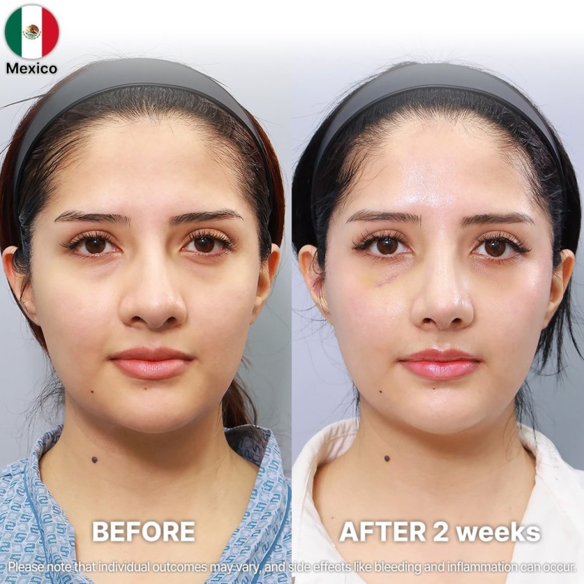 Vorher-nachher-Ergebnisse der Nasenkorrektur bei Returning Plastic Surgery in Mexiko