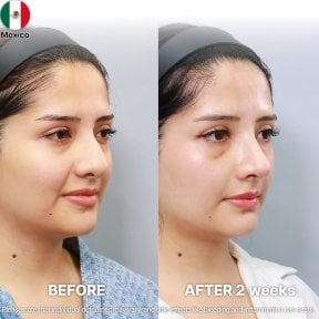 نتائج عملية تجميل الأنف قبل وبعد في Returning Plastic Surgery بعد أسبوعين