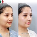 نتائج عملية تجميل الأنف قبل وبعد في Returning Plastic Surgery بعد أسبوعين