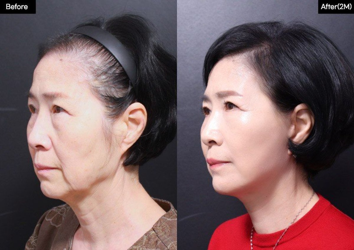 Facelift Vorher-Nachher-Ergebnisse bei VG Plastic Surgery, sichtbare Verjüngung und Straffung