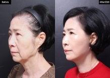 Resultados de lifting facial antes y después en VG Plastic Surgery, rejuvenecimiento visible