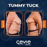 Vorher-nachher-Ergebnis Bauchdeckenstraffung bei Adem and Havva Medical Center – flacher Bauch