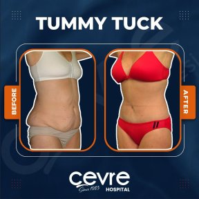 Vorher-nachher-Ergebnis Bauchdeckenstraffung bei Cevre Hospital, sichtbare Konturverbesserung