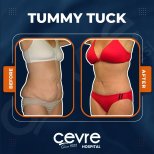 Vorher-nachher-Ergebnis Bauchdeckenstraffung bei Cevre Hospital, sichtbare Konturverbesserung