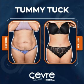 Vorher-nachher-Ergebnis Bauchdeckenstraffung bei Adem and Havva Medical Center, flacher Bauch