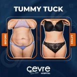 Vorher-nachher-Ergebnis Bauchdeckenstraffung bei Adem and Havva Medical Center, flacher Bauch